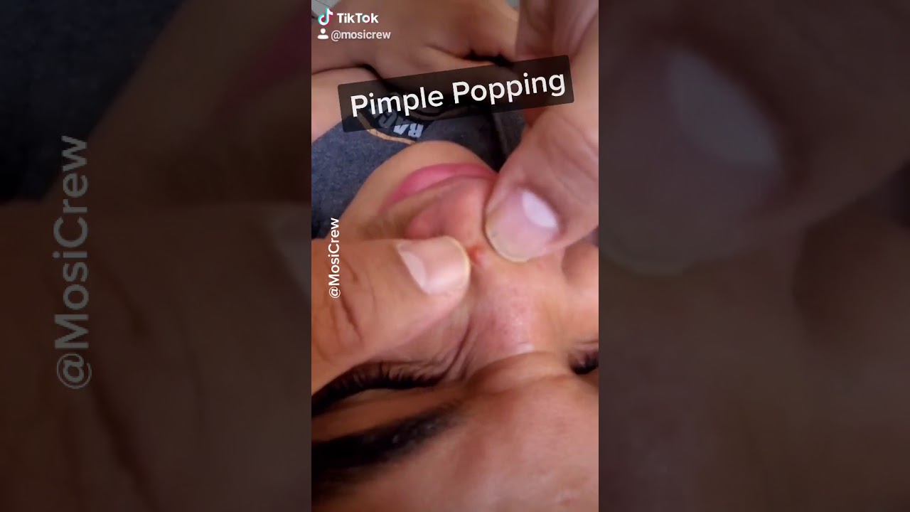 Best Nose Pimple Popping