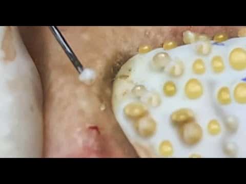 Best of Acne, Pimples & Popping!  So Many Pimple Pops!