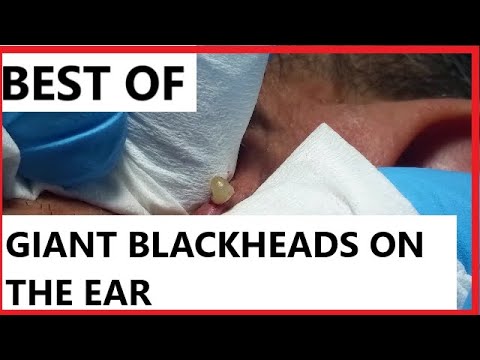 Best of Giant Blackeads on The Ear