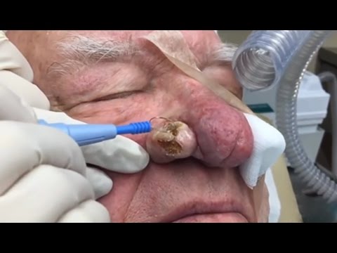 Best of People Removing Zits Popping Pimples – Pimples Pop Removal Compilation