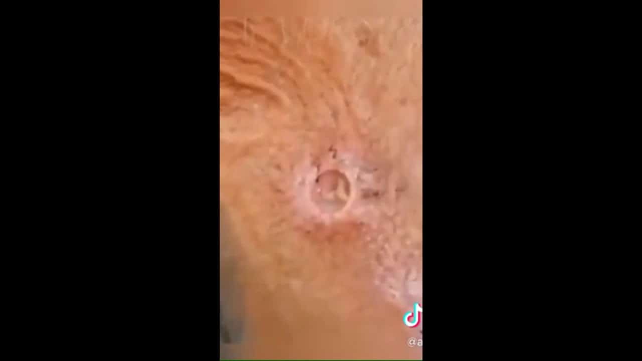 Best of TikToks PIMPLEPOPPING | Compilation of PIMPLE POPPING |INCREDIBLE AND SATISFYING