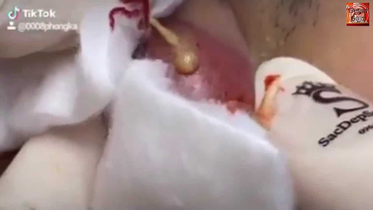 Best Pimple popping 2020