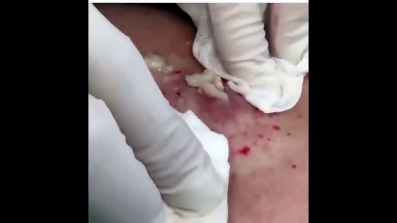 Best Pimple Popping and Cyst Removal Compilation!
