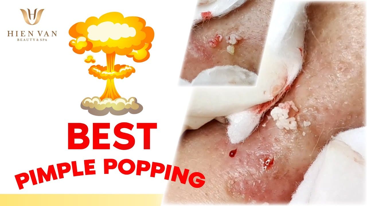 Best Pimple Popping! Điều trị mụn hiệu quả nhất TPHCM tại Hiền Vân SpaI Trần Xuân Trường I Bài 418