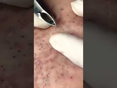BEST PIMPLE POPPING EVER *SATISFACTION*