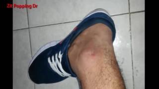 Best Pimple Popping On Leg YouTube cary