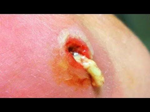 Best pimple popping video on internet