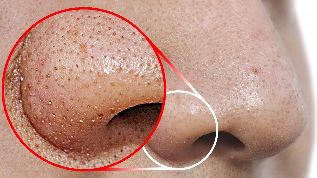 Best Pimple Popping Videos – Blackheads Nose