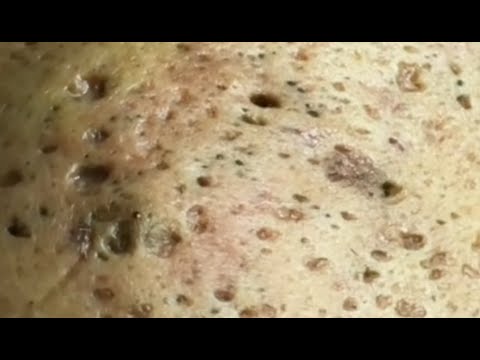 Best Pimple Popping Videos- Deep Blackheads Removal from Cheeks and Nose