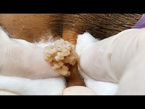 Best Pimple Popping Videos Large Blackheads Remove Blackheads Ep 1