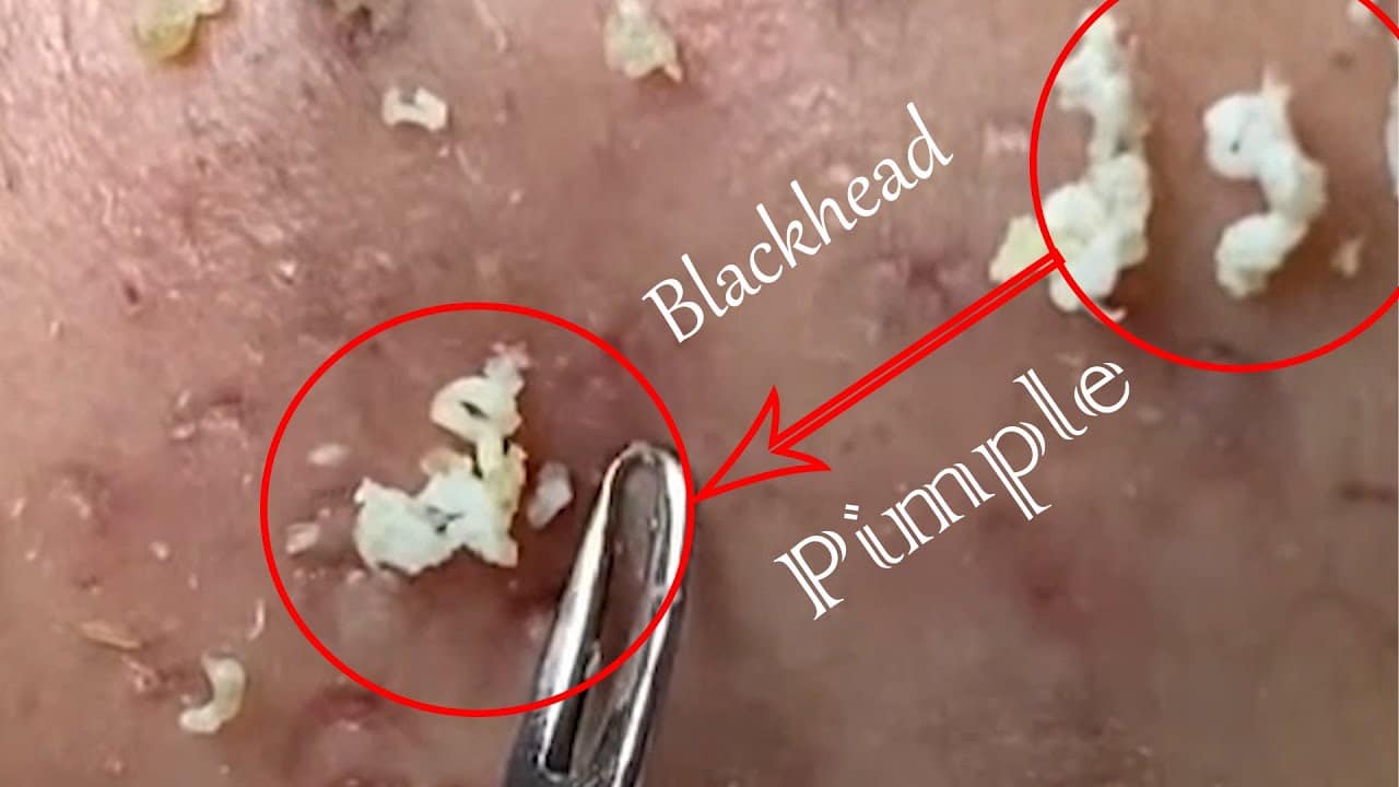 Best Pimple Popping Videos Large Blackheads Remove Blackheads Ep 41