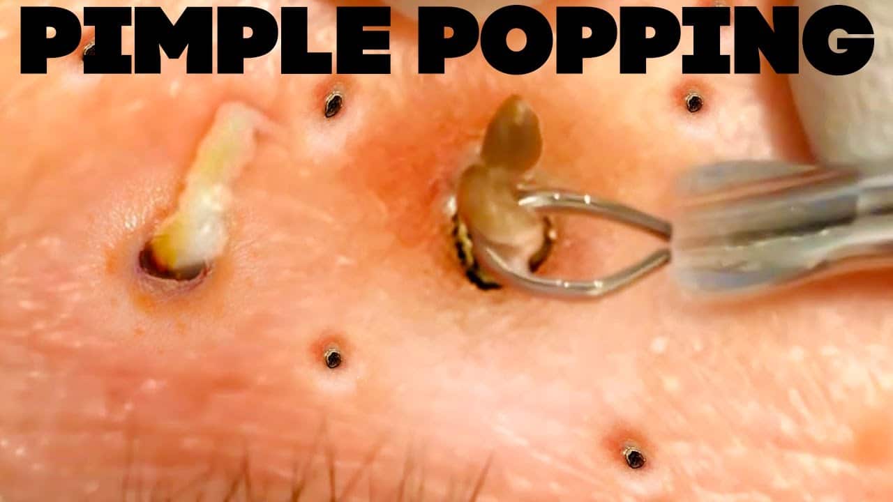 Best Pimple Popping Videos of 2021