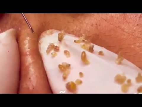 Best Pimple Popping Videos – Pimple Popping – Blackheads Removal on the Face