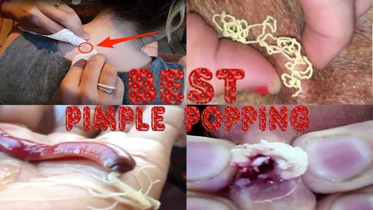 🔴 Best Pimple Popping Videos 🔴 popping huge blackheads and pimple popping 🔴 cysts this week 🔴