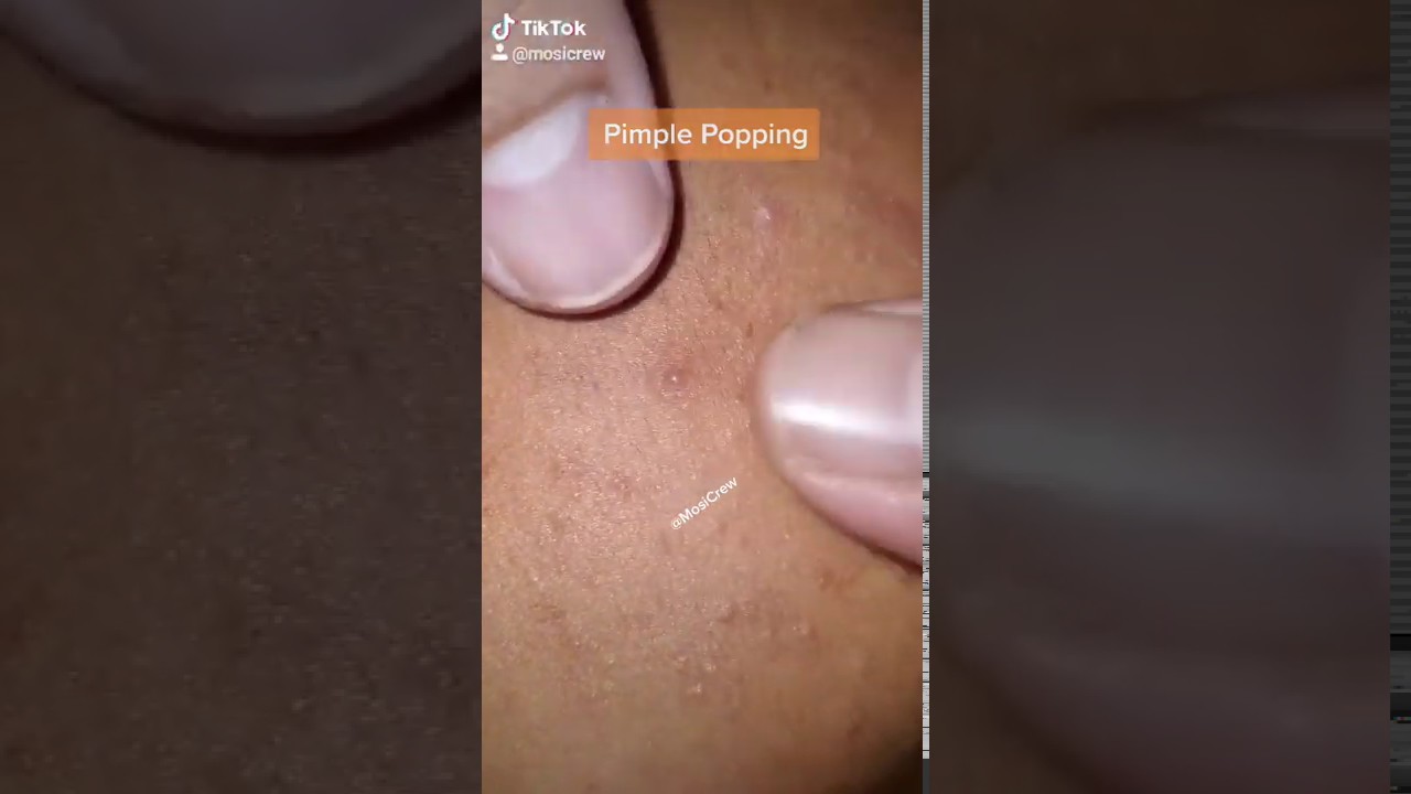 Best Pimple Popping with thumbs