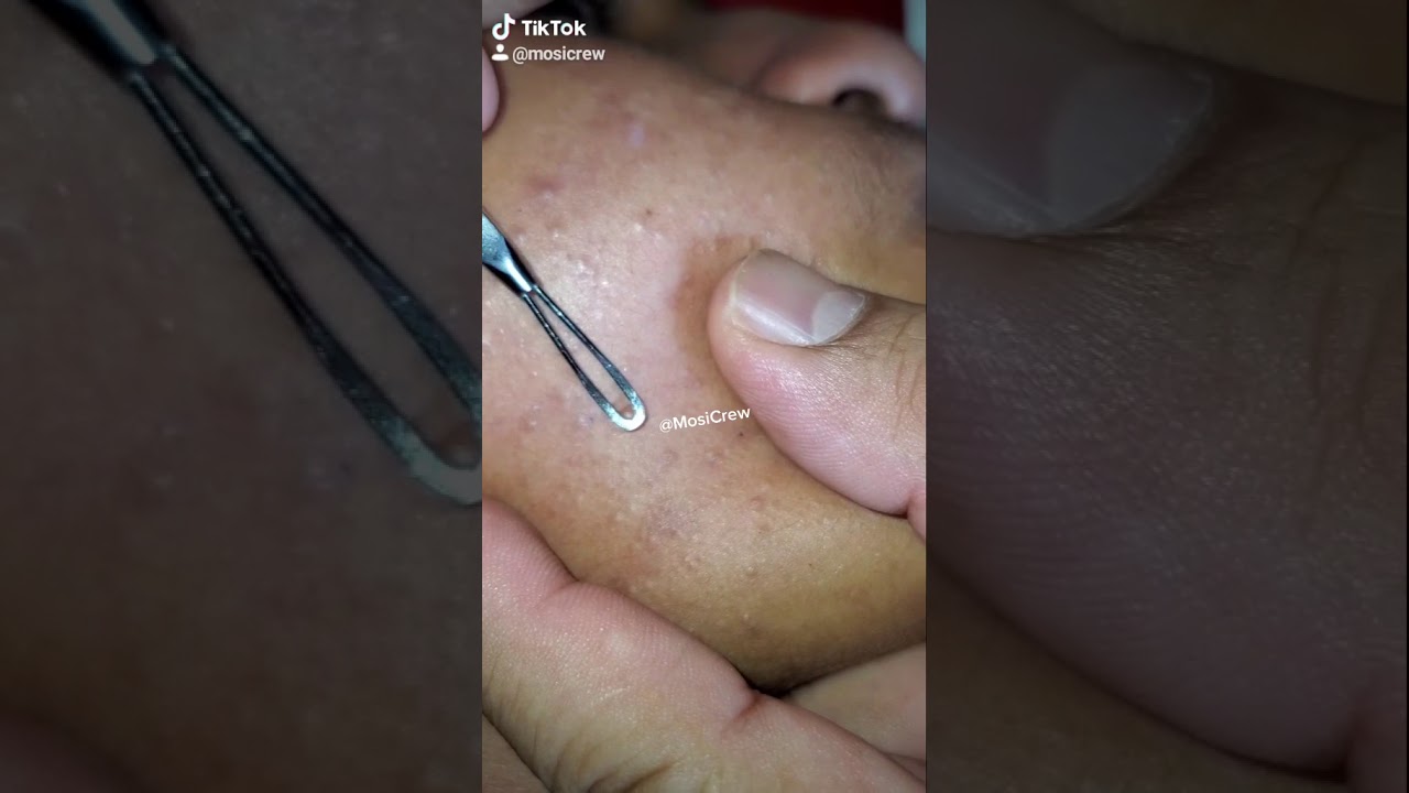 Best Pimple Popping