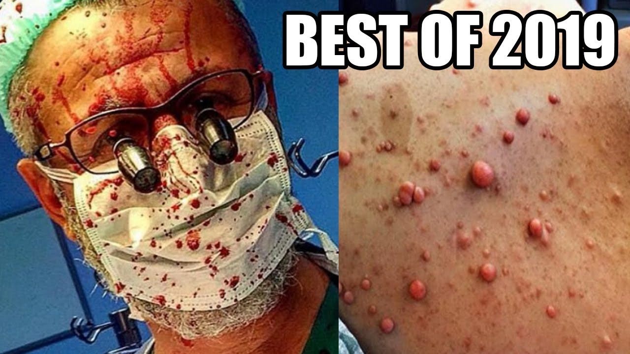 Best Pimple Pops of 2019, Biggest Zits, Whiteheads & Blackheads