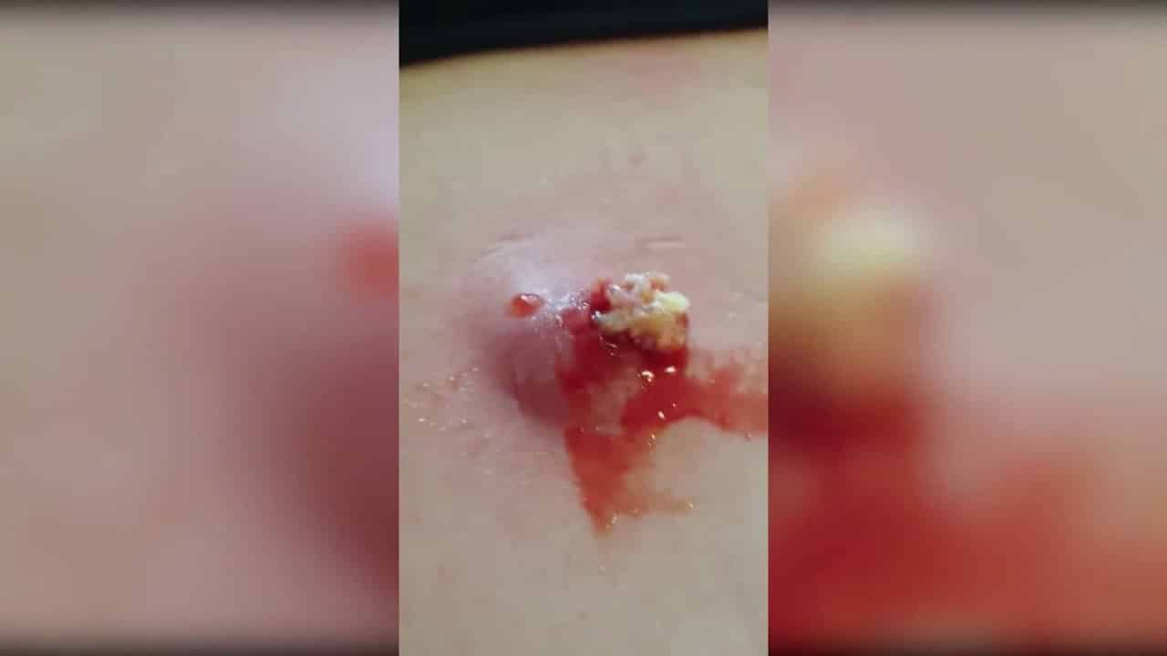 Best Pimple Videos – Popping Huge Blackheads And Pimple Popping#20, #acne #winspa #loannguyen