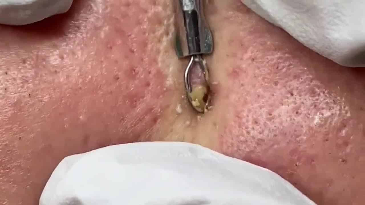 Best Pimples Popping Videos (Blackheads Removal)
