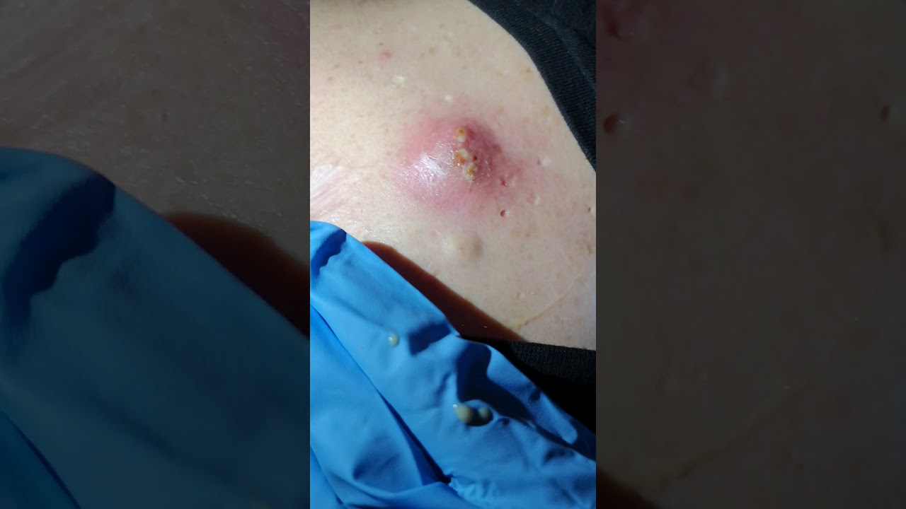 Best pipple pop of 2019 EXPLODING Spot/Pimple/Cyst popping