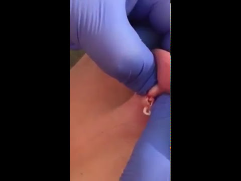 Best popping pimple pus ever gross pimple popping Human’s popping pimple on back of ear