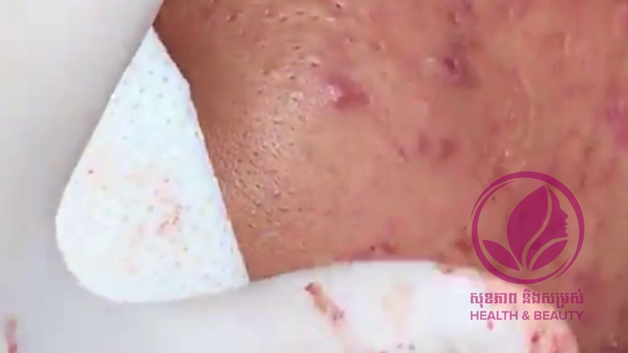 Best Removal Pimple Popping Blackheads, Whiteheads on The Face – Acne Treatment