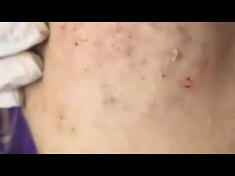 Best Removal Pimple Popping Blackheads – large blackheads removal – best pimple popping videos #28