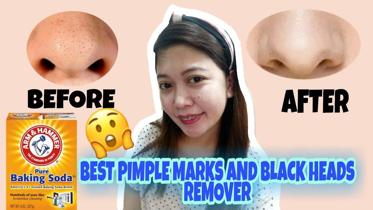 BEST REMOVER OF PIMPLE MARKS AND BLACKHEADS | BAKING SODA REVIEW