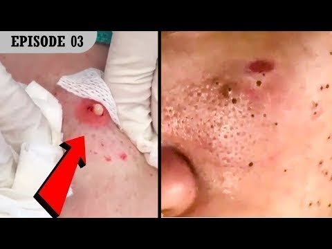 Best Satisfying Blackheads Removing & Pimple Popping Compilation #3
