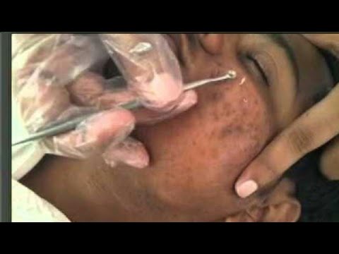 Best Satisfying Blackheads Removing & Pimple Popping Compilation #24 2019 Peter Freight