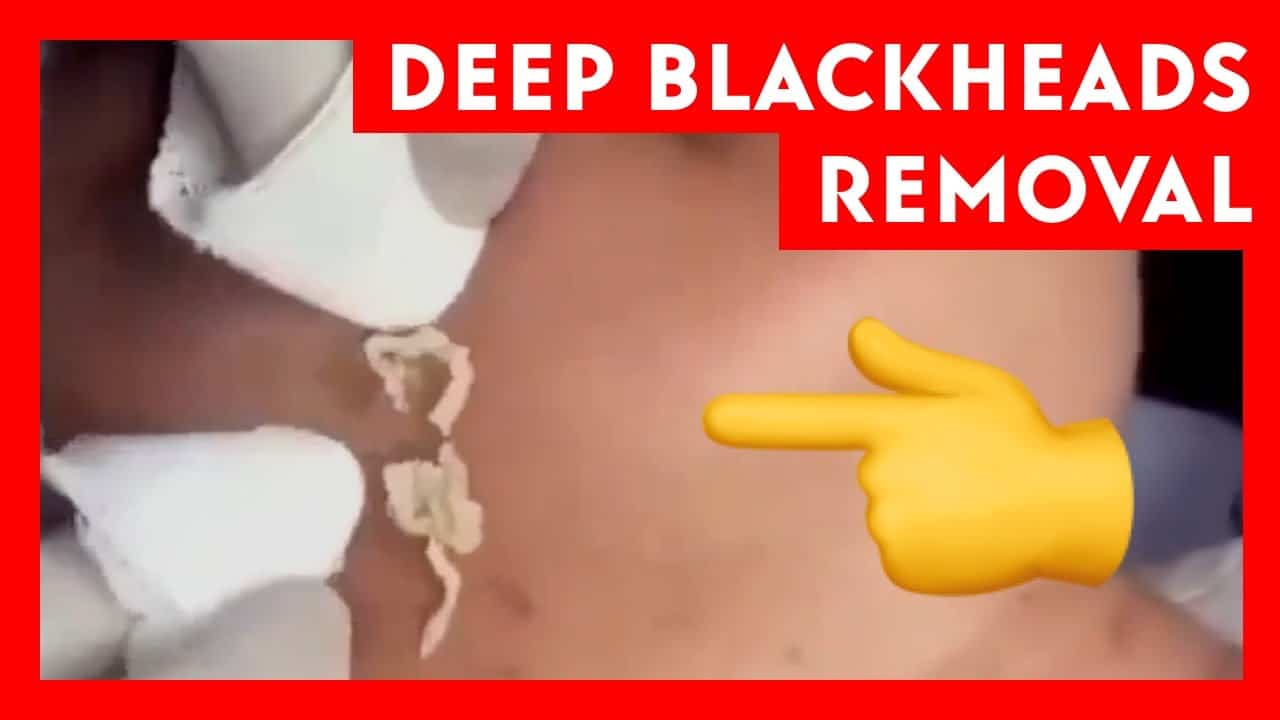 Best Satisfying Pimple Popping Compilation | ASMR Blackheads Removal