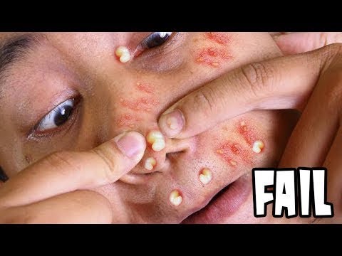 Best Satisfying Pimple Popping Compilation 2019 – Viewire