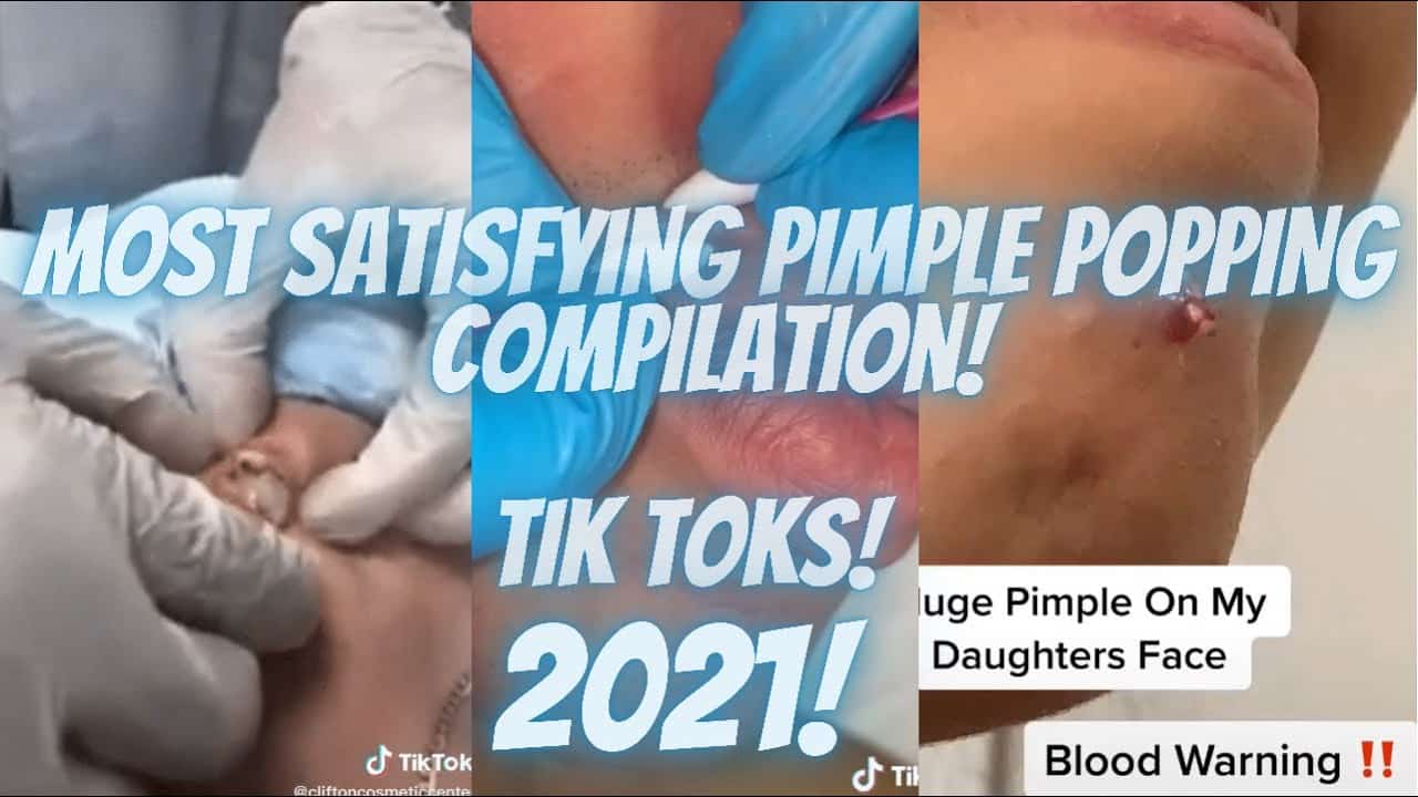 ⚠️BEST SATISFYING PIMPLE POPPING COMPILATION|2021|TIK TOKS.