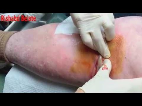 Best Terrible Infection Pimple POPPING