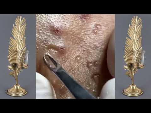 Best Vevo Blackheads removal | Vevo dr Acne Treatment |pimple popping | acne by Vevo.dr acne 012