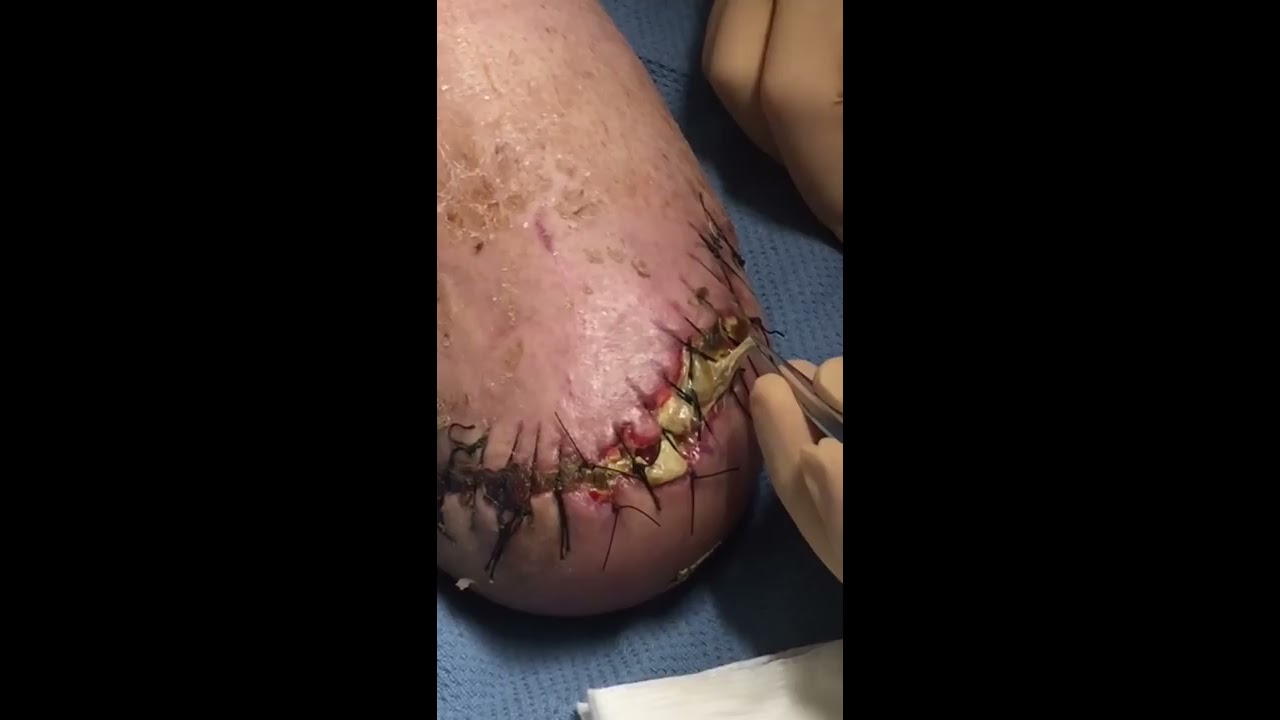 Better than pimple popping!!!-Debridement of Wound