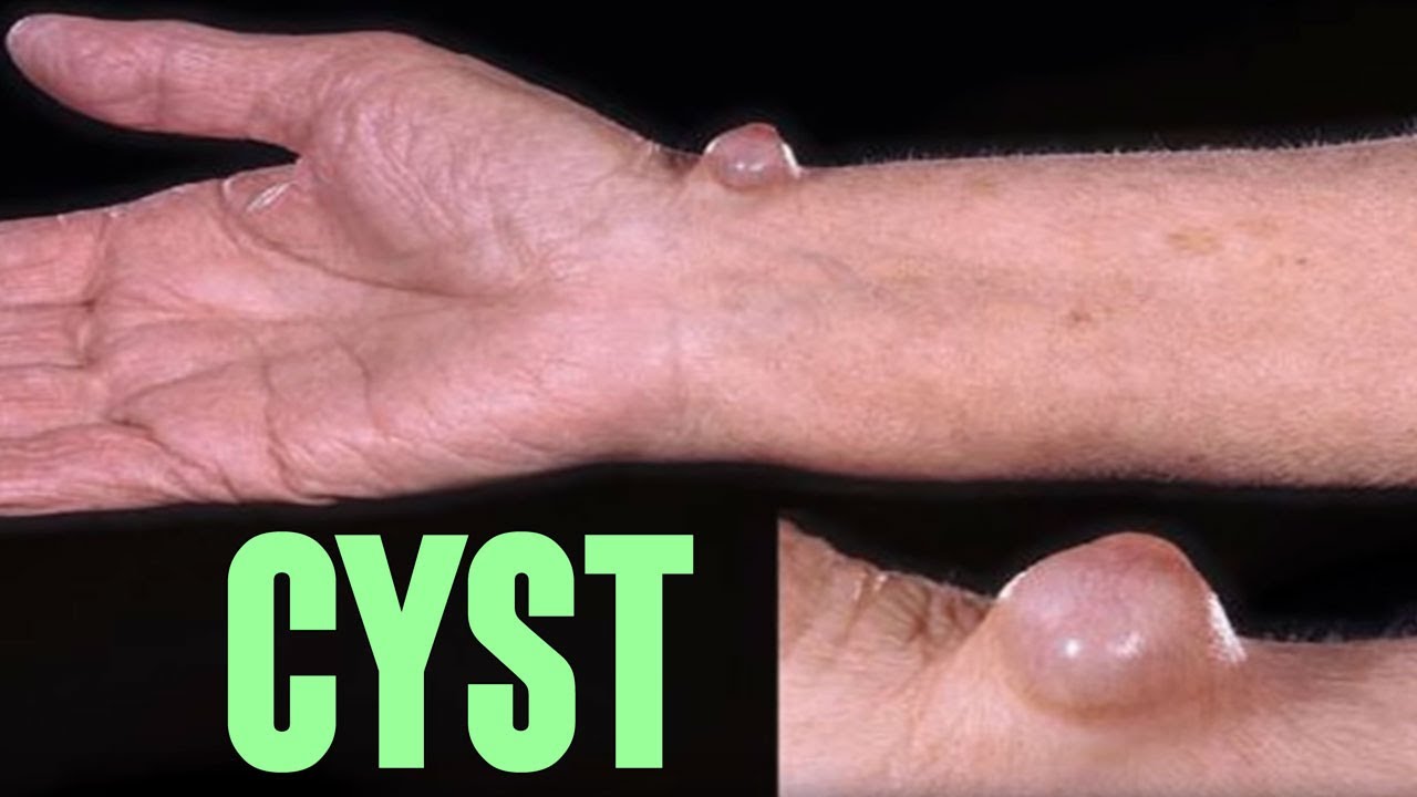 Bible Cysts!   Pop or Smash Them?