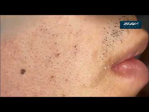 Big Blackheads Extraction Blackheads Whiteheads Removal Pimple Popping