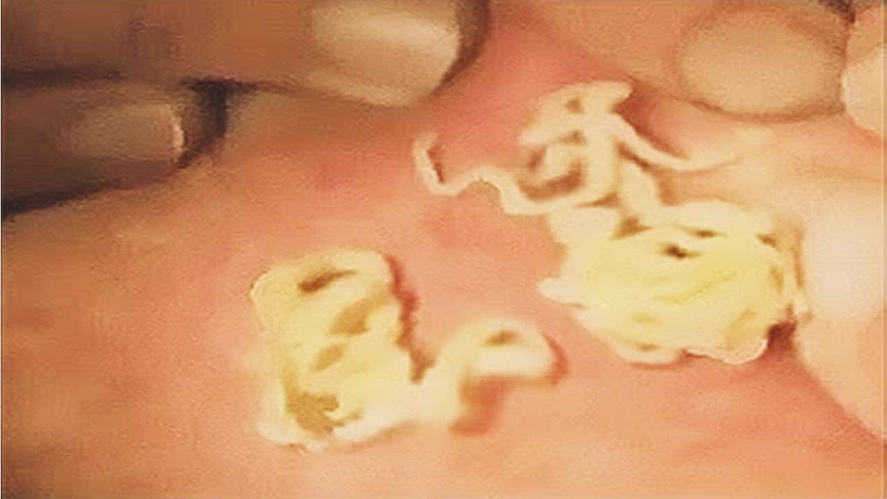 Big Cyst Pimple Popping Videos – Pimple Removal Videos