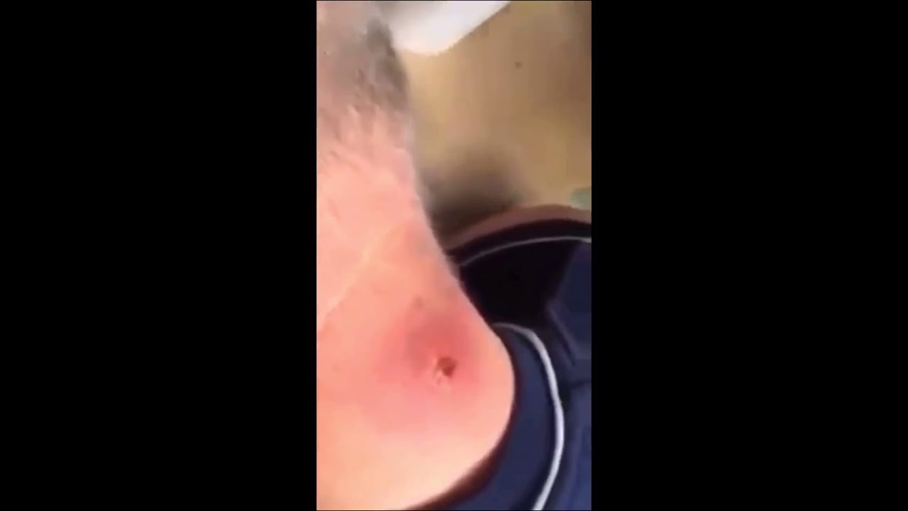 Big cyst/ pimple popping