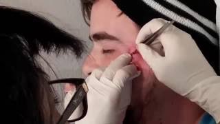 Big cyst pop on face young man rupture during removal !! cary