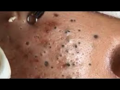 Big cystic Acne Blackheads Acne treatment Relaxing Satisfying video 2021