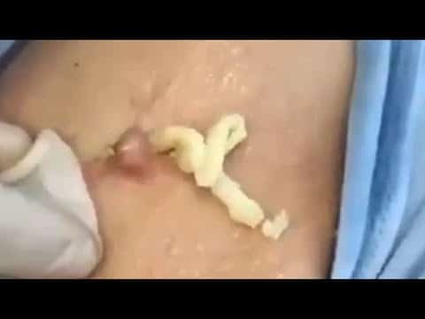 Big Cystic Acne Blackheads Extraction Blackheads & Milia, Whiteheads Removal Pimple Popping #183
