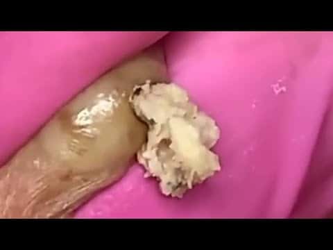 Big Cystic Acne Blackheads Extraction Blackheads & Milia, Whiteheads Removal Pimple Popping #182