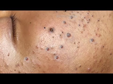 Big Cystic Acne Blackheads Extraction Blackheads & Milia, Whiteheads Removal Pimple Popping #06