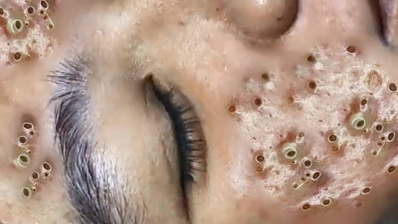 Big Cystic Acne Blackheads Extraction Blackheads & Milia, Whiteheads Removal Pimple Popping AB2