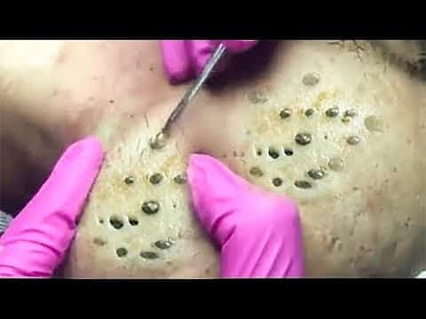Big Cystic Acne Blackheads Extraction Blackheads & Milia, Whiteheads Removal Pimple Popping 6