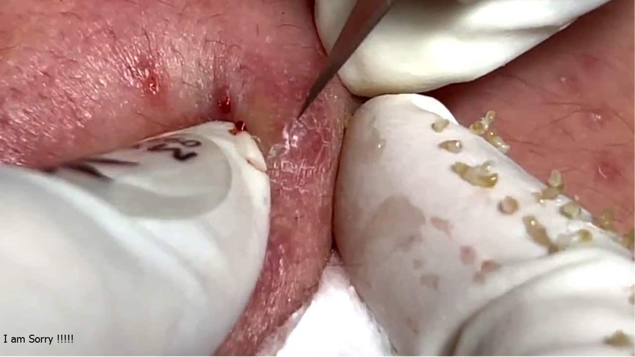 Big Cystic Acne Blackheads Extraction Whiteheads Removal Pimple Popping#13