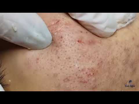 Big Cystic Acne Blackheads Extraction Blackheads & Milia, Whiteheads Removal Pimple Popping S014