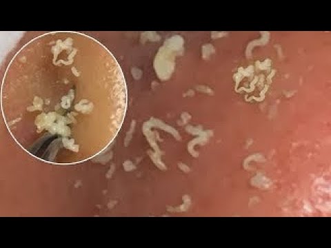 Big Cystic Acne Blackheads Extraction Blackheads & Milia, Whiteheads Removal Pimple Popping S015